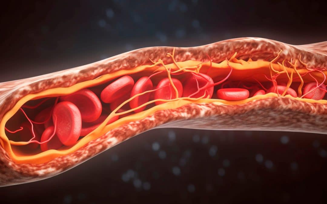How To Reduce Your Stroke Risk?