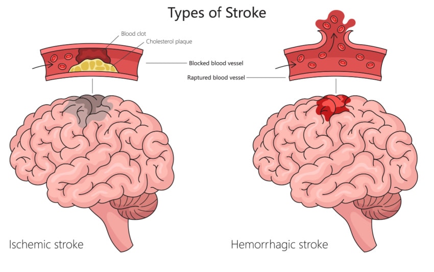 Types of Strokes