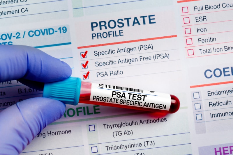 PSA Blood Test for Prostate Health at Universal Ultrasound Diagnostics PSA Blood Test for Prostate Health at Universal Ultrasound Diagnostics