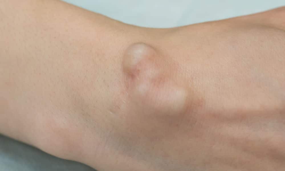 Lumps and Bumps Ultrasound Lumps and Bumps Ultrasound