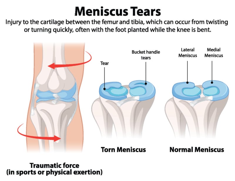 What is a Meniscal Tear What is a Meniscal Tear