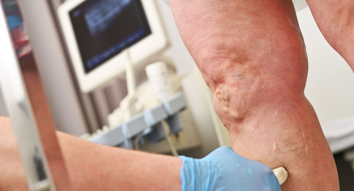 Chronic venous disease Chronic venous disease Scan