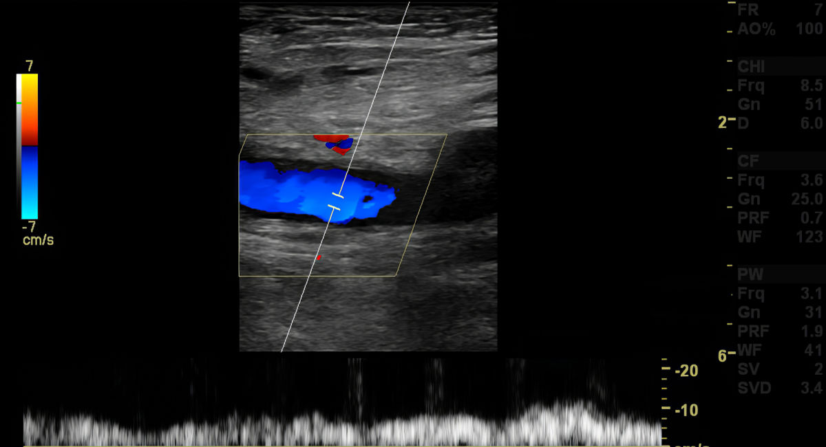 Duplex Ultrasound finding deep vein thrombosis or DVT. Duplex Ultrasound