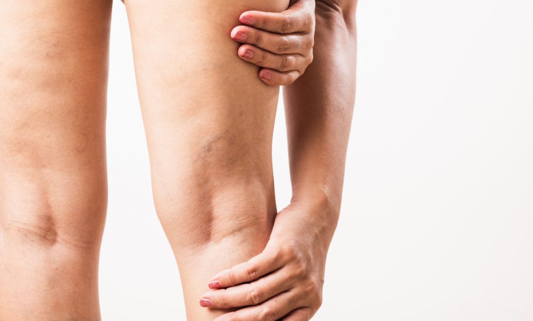 Venous Insufficiency Explained: Prevention, Diagnosis, and the Role of Ultrasound