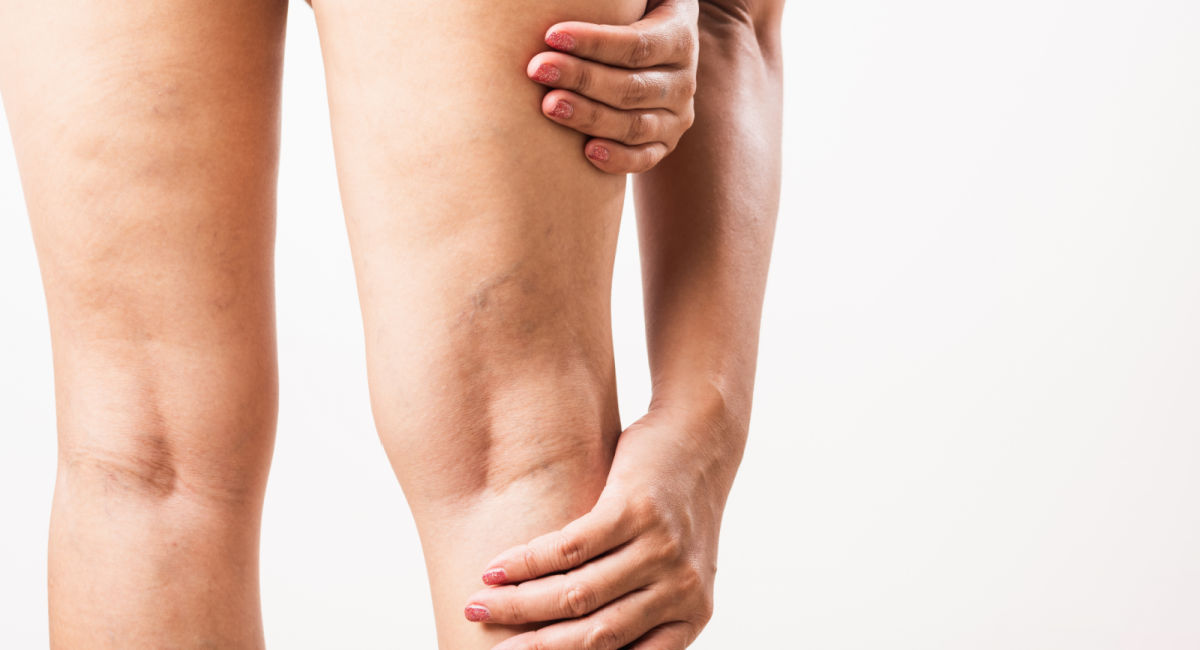 Venous Insufficiency Ultrasound Diagnostic