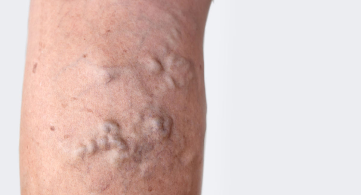 Venous Insufficiency Reflux Venous Insufficiency Reflux symptoms